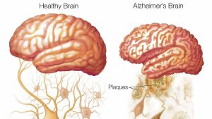 Alzheimer's Science Bee Science News
