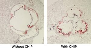 Clonal Hematopoiesis